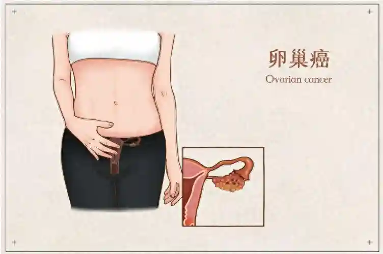 吉卡科普|组织驻留记忆T细胞调控卵巢癌症免疫反应