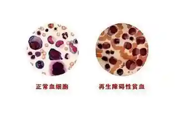 中医药膳之慢性再生障碍性贫血